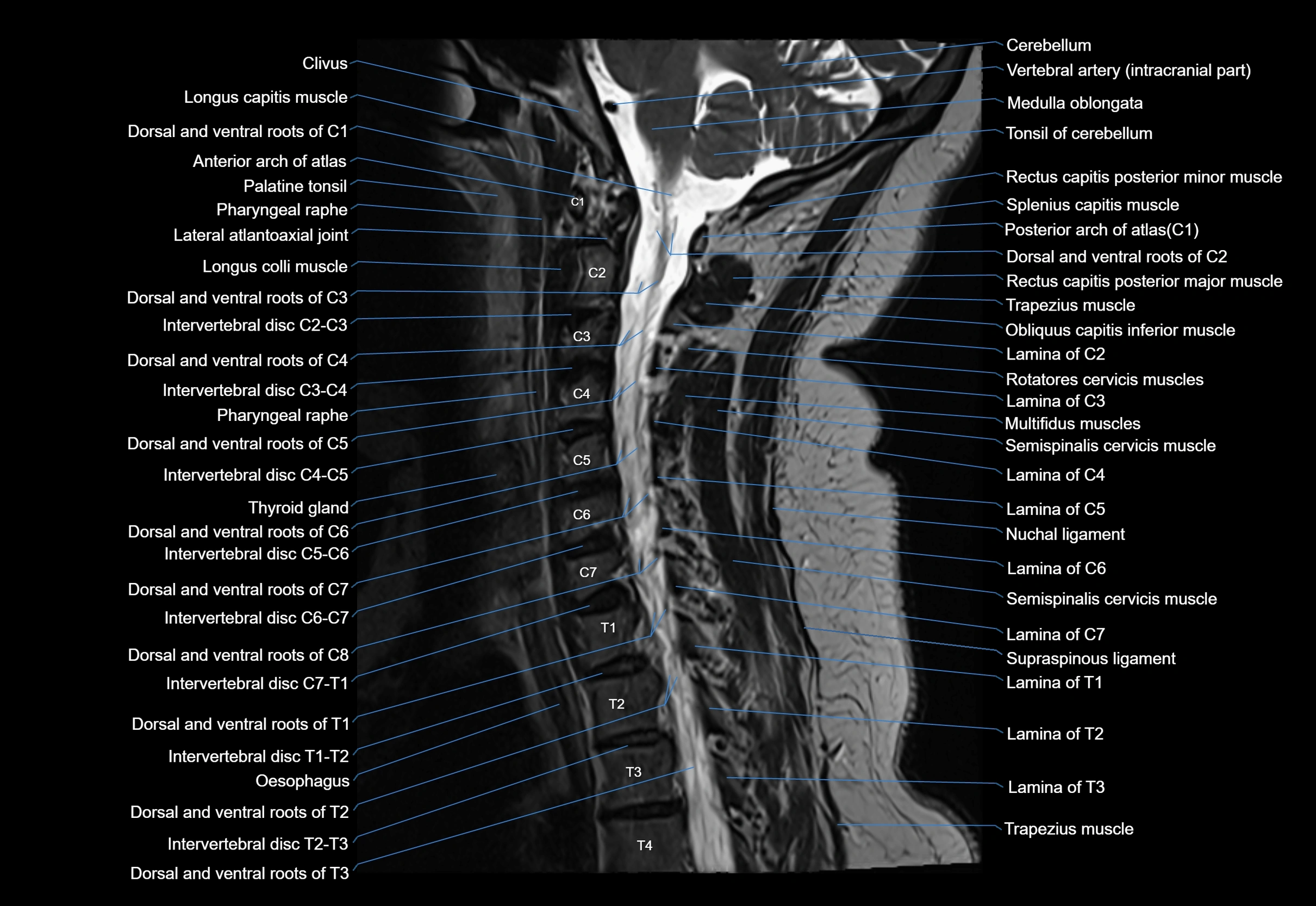cervical spine cross sectional MRI anatomy 3T MRI  sagittal image-img-00001-00020.webp